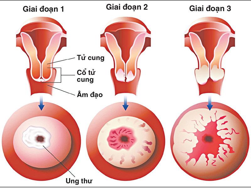 Vị trí ung thư cổ tử cung