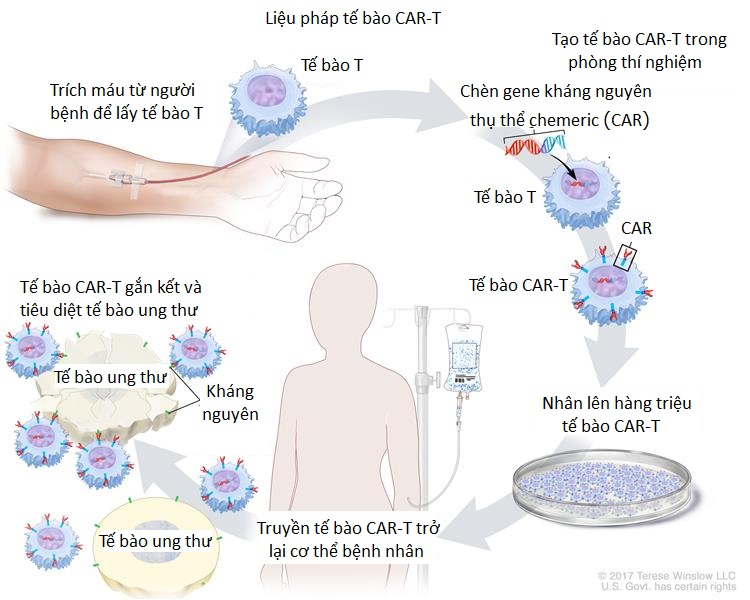 Liệu trình tế bào CAR-T