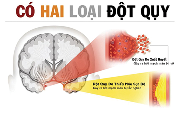 Các loại đột quỵ