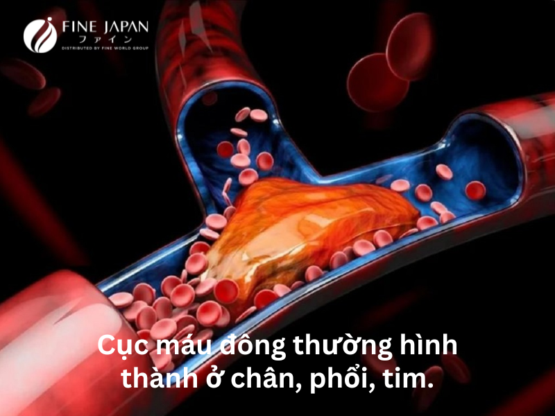 Cục máu đông thường hình thành ở chân, phổi, tim.