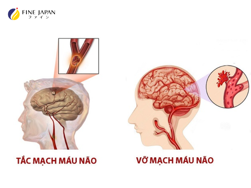 Tắc mạch máu não và Vỡ mạch máu não