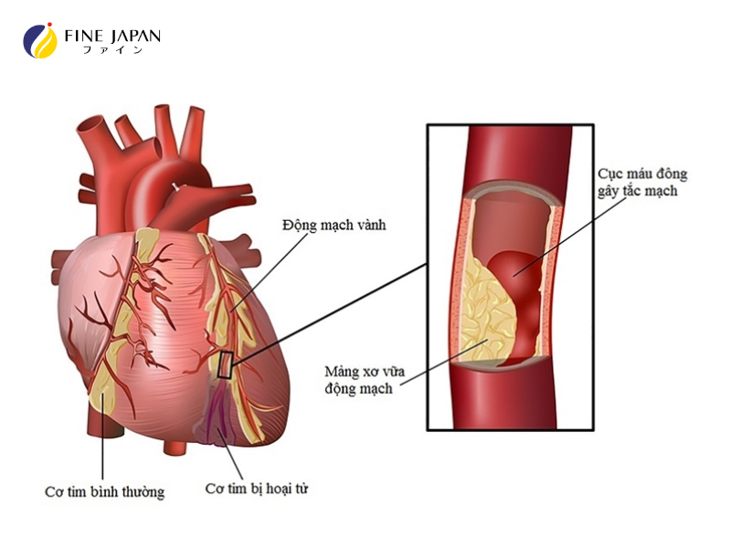Tắc động mạch vành