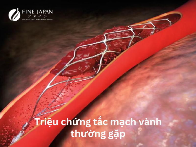 Triệu chứng của tắc động mạch vành có thể khác nhau tùy thuộc vào mức độ tắc nghẽn