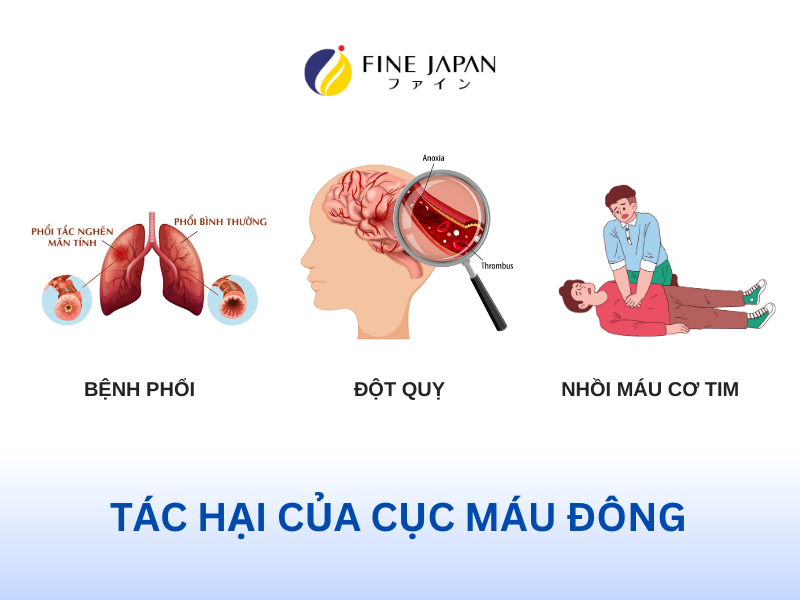 Cục máu đông dẫn đến nhiều hệ lụy nguy hiểm.