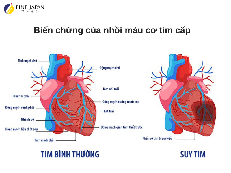 Biến chứng của nhồi máu cơ tim cấp